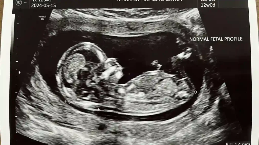  A clear profile ultrasound of a 12-week fetus showing the nasal bone and Nuchal Translucency.