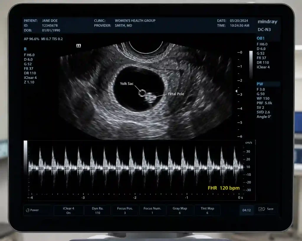 Transvaginal ultrasound at 6 weeks showing the fetal pole and heartbeat waveform.