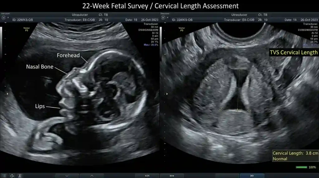 Ultrasound at 22 weeks focusing on fetal facial profile and cervical length measurement.