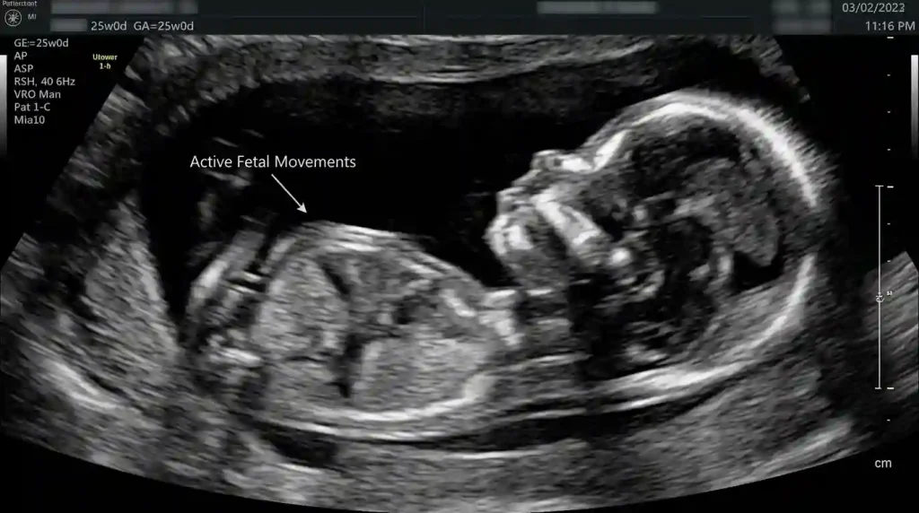 Ultrasound of a 25-week fetus showing fetal breathing movements and hair on the scalp.