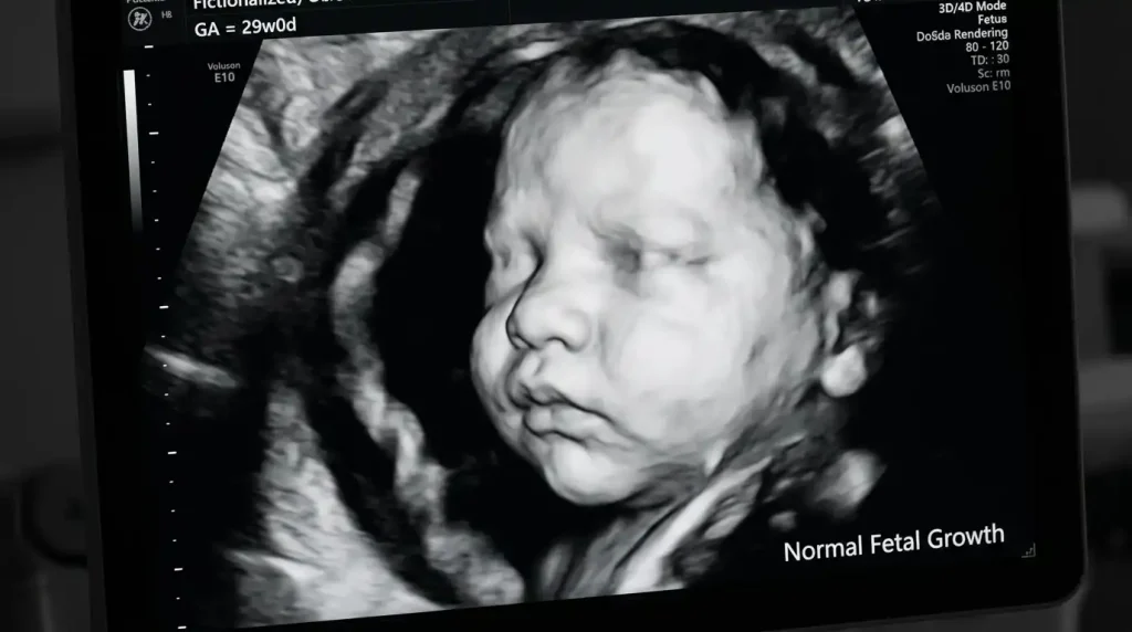 Ultrasound of a 29-week fetus highlighting facial fat accumulation and amniotic fluid pockets