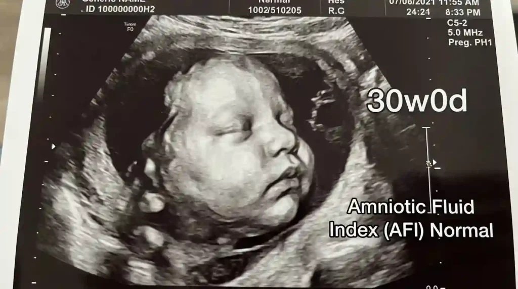  Ultrasound of a 30-week fetus showing limited space and measuring amniotic fluid index.